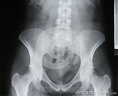 osteoporosis x ray. X-RAY, OSTEOPOROSIS (click