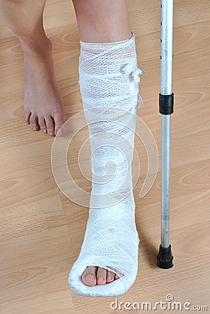 broken leg pictures. BROKEN LEG (click image to