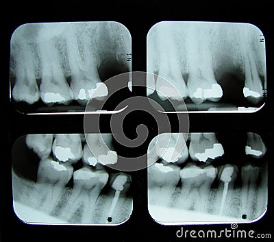 dental X-Rays
