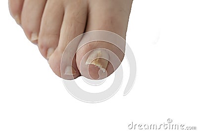 FUNGAL NAIL INFECTION ISOLATED (click image to zoom)