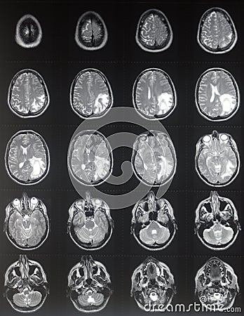 mri brain scan. MRI BRAIN TUMOR (click image