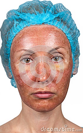 Chemical Free Makeup on Royalty Free Stock Image  Skin Condition After Chemical Peeling Tca