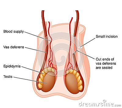 How Is A Vasectomy Performed. Photo of Vasectomy