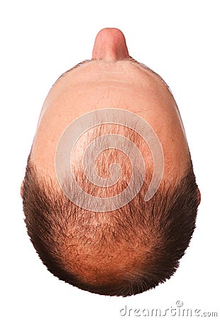 New genetic discoveries related to male pattern baldness